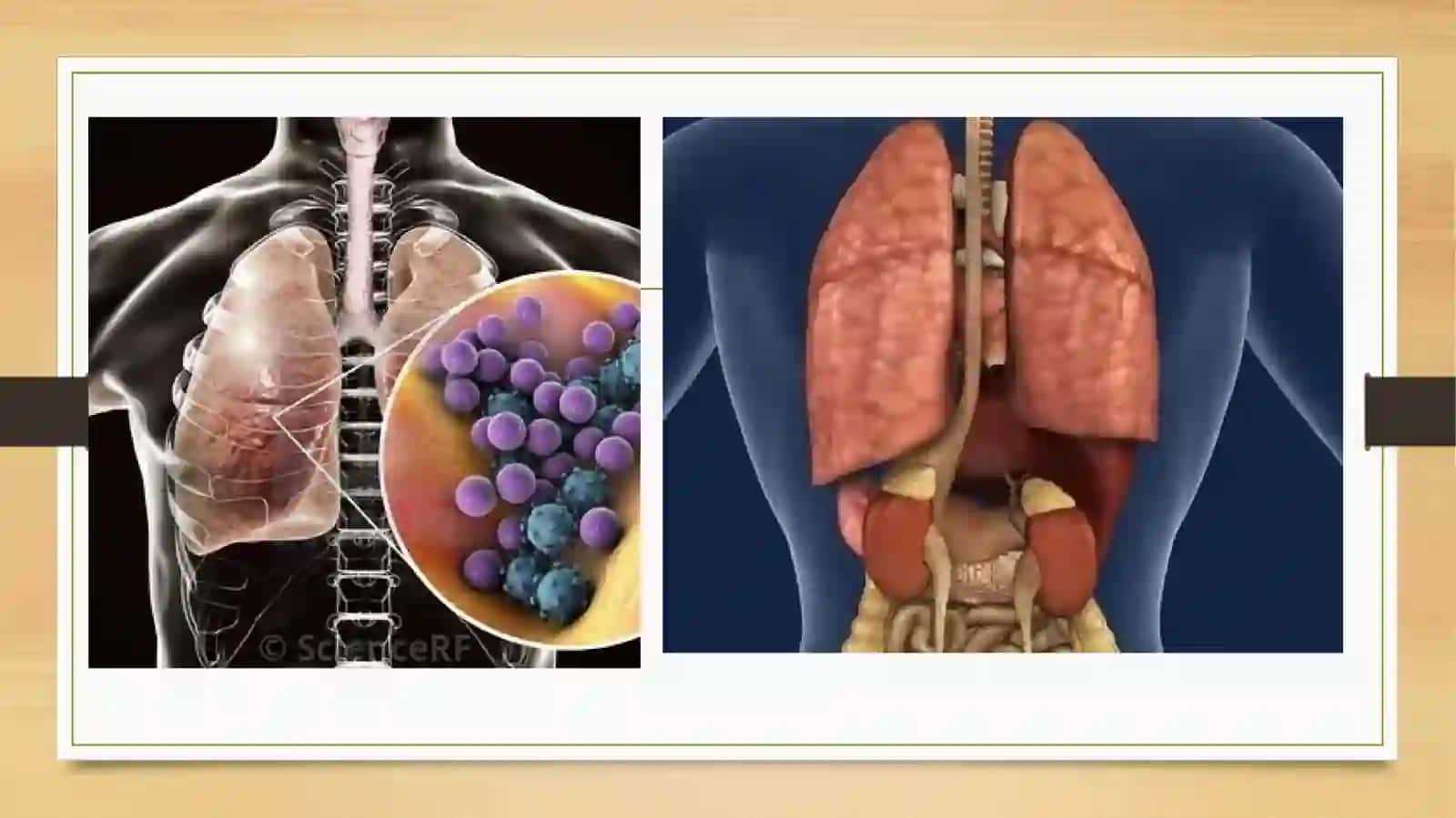O’pkaning yallig’langan o’chiq tuberkulozi, O’pka tuberkulomasi, klinsikasi, tashxisi, o’ziga hos kesish 4