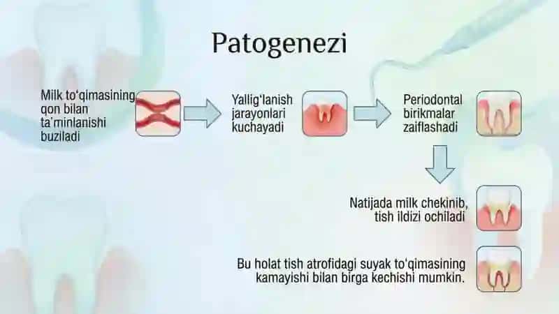 Milk resessiyasi. Klinikasi, qiyosiy tashxisi, davolash, profilaktika 4