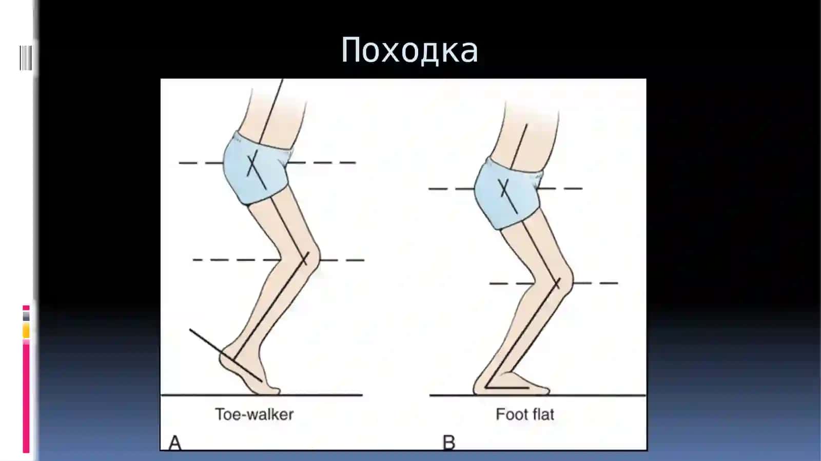 Ортопедические аспекты детского церебрального паралича 4