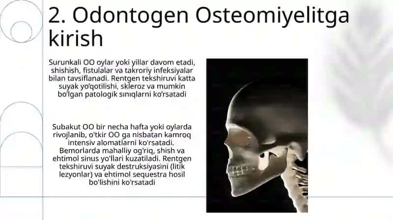 O'tkir odontogen osteomiyelit 4