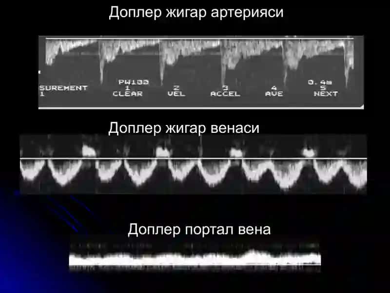 Жигар касalliklari nur tashxisi 4