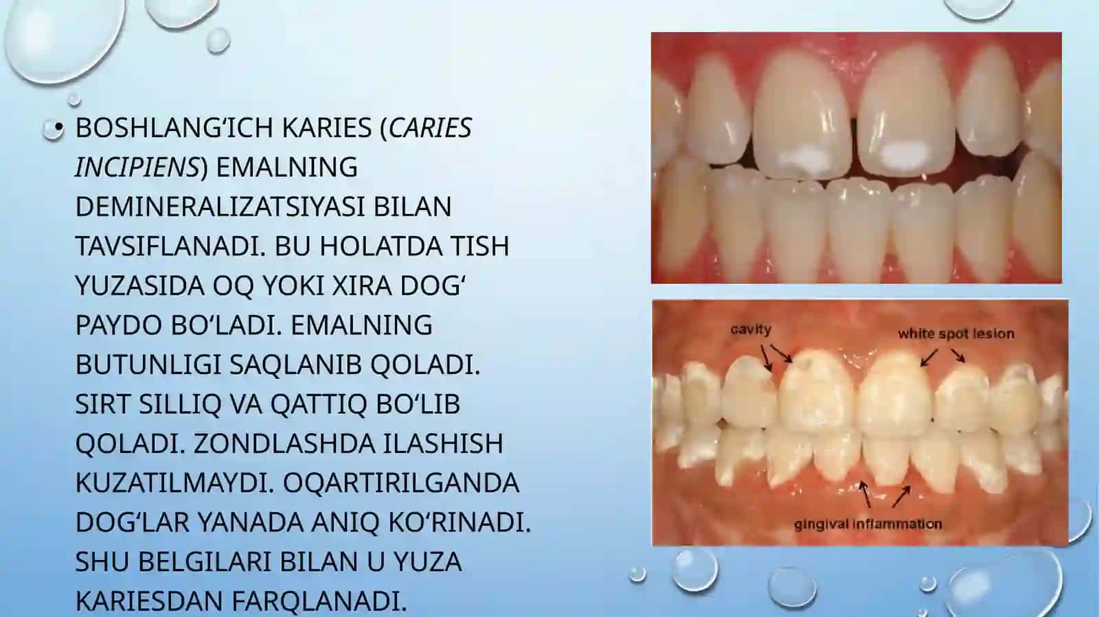 YUZA KARIES VA BOSHLANG‘ICH KARIESNI QIYOSIY TASHHISLASH 4