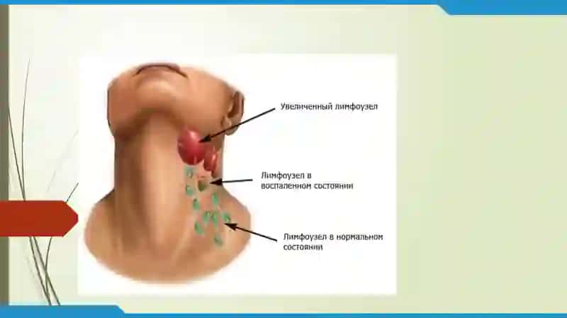 Лимфомалар\ Limfomalar 4