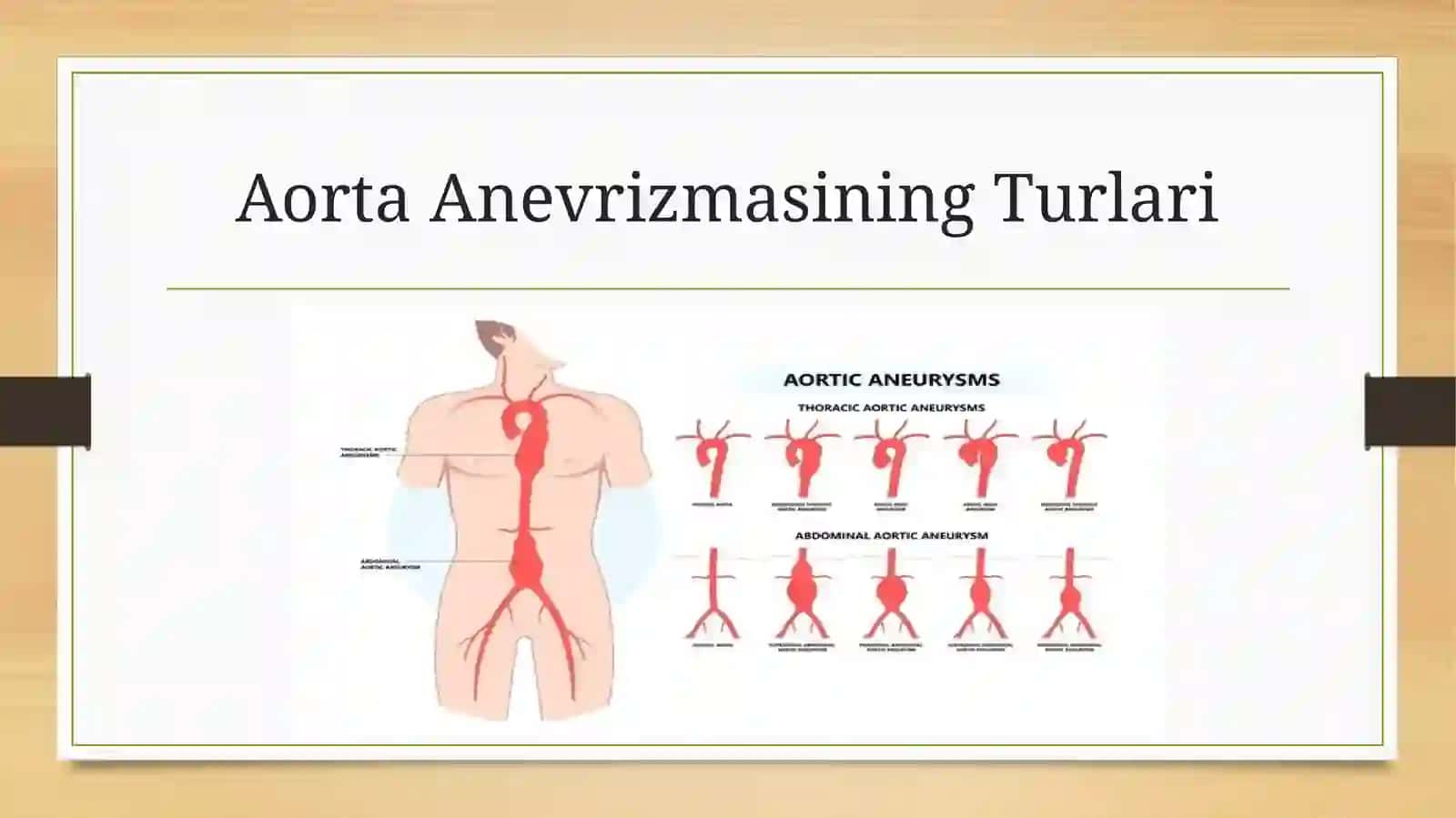 Aorta anevrizmasi 4