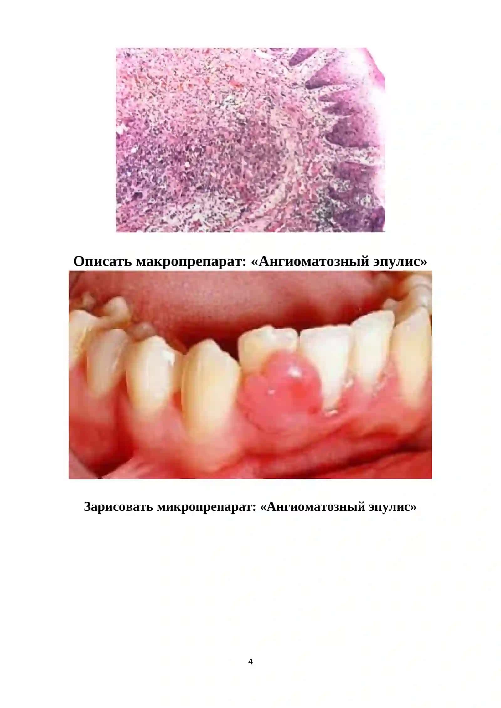 Опухолеподобные заболевания зубов 4
