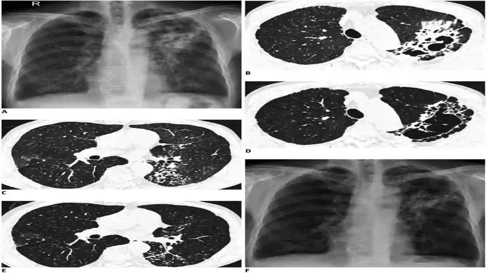 Tuberkulyozning destruktiv shakllari — kavernali va fibroz-kavernali tuberkulyoz 4