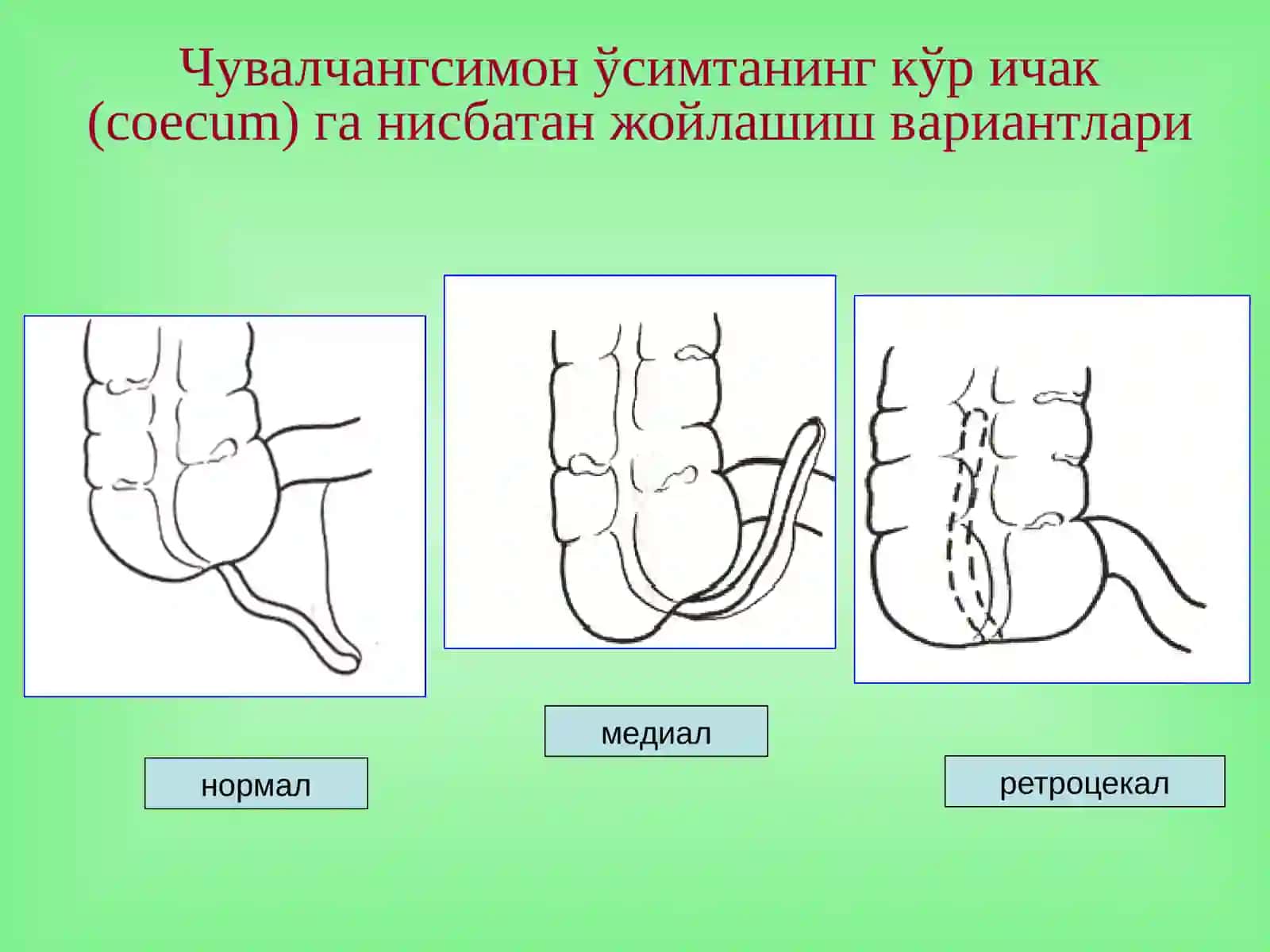 Аппендицит асоратлари 4