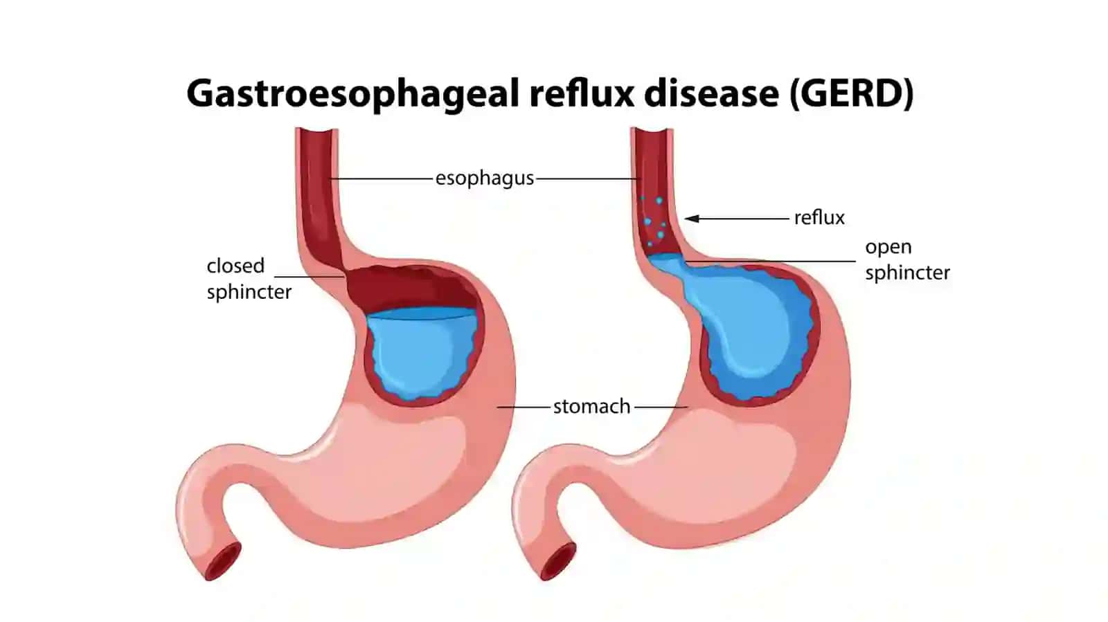 Qizilo‘ngach (Esophagus) 4