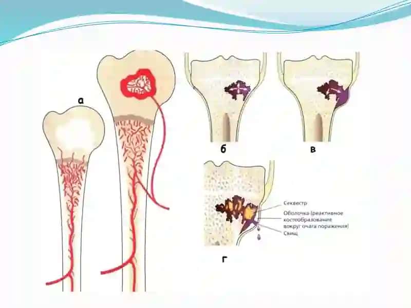 Gematogen osteomielit 4