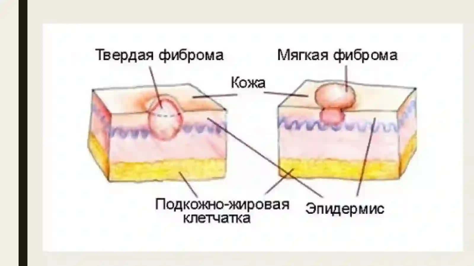Yuz-jag‘ sohasi yumshoq to‘qimalari xavfsiz o‘smalari va o‘smasimon hosilalari(fibroma,fibramatoz, epulis, lipoma, gemangioma, limfangioma) 4