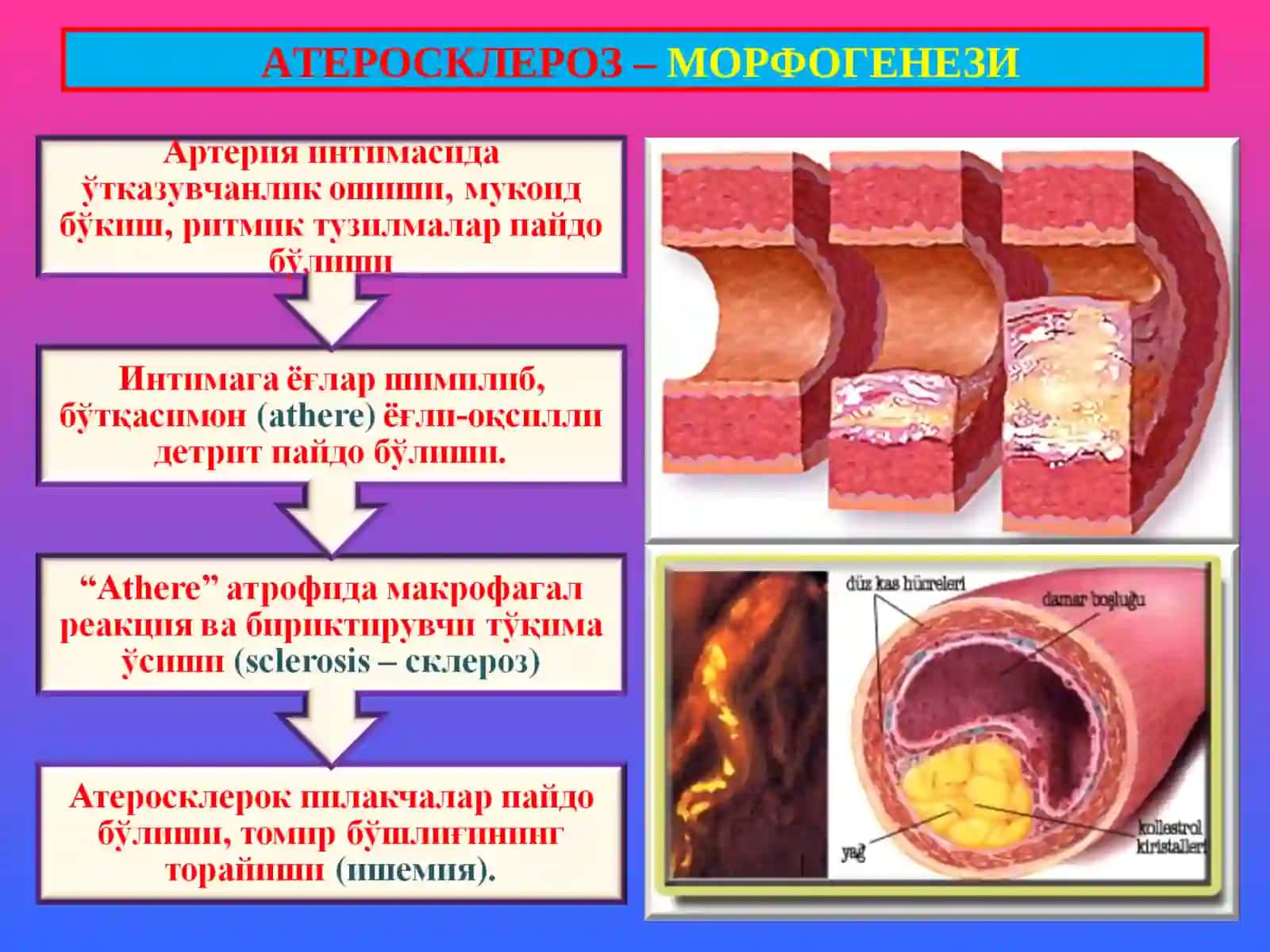 ПАТОЛОГИК АНАТОМИЯ 14- маъруза “Атеросклероз. Гипертония касаллиги” 4
