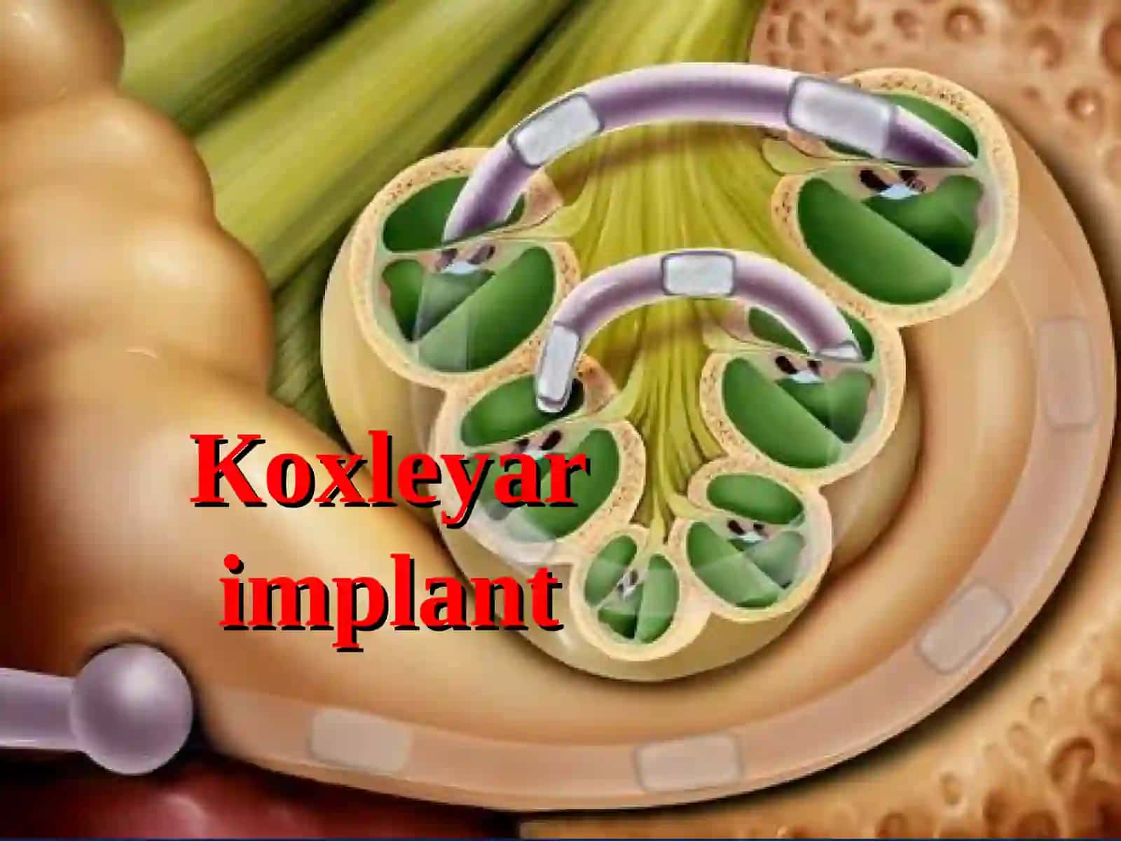 Koxlear implantatsiya: texnologiya, tibbiyot, surdopedagogika va logopediyaning rivojlanishidagi innovatsiya 4