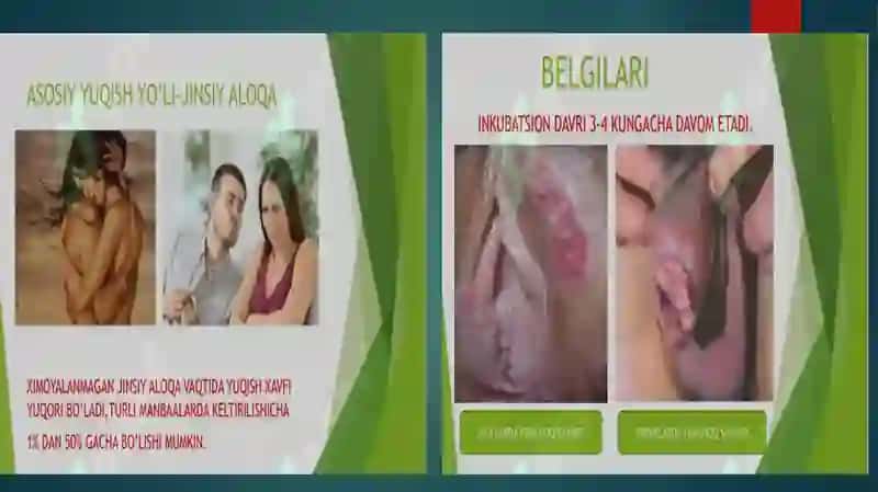 Yumshoq Shankar.Venerik Limfogranulema.Donovanoz.Zahmnining Yomon Sifatli Kechishi Haqida Tushuncha 4