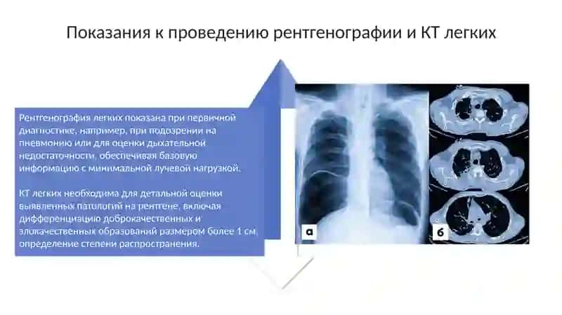 Рентгени КТлегких 4