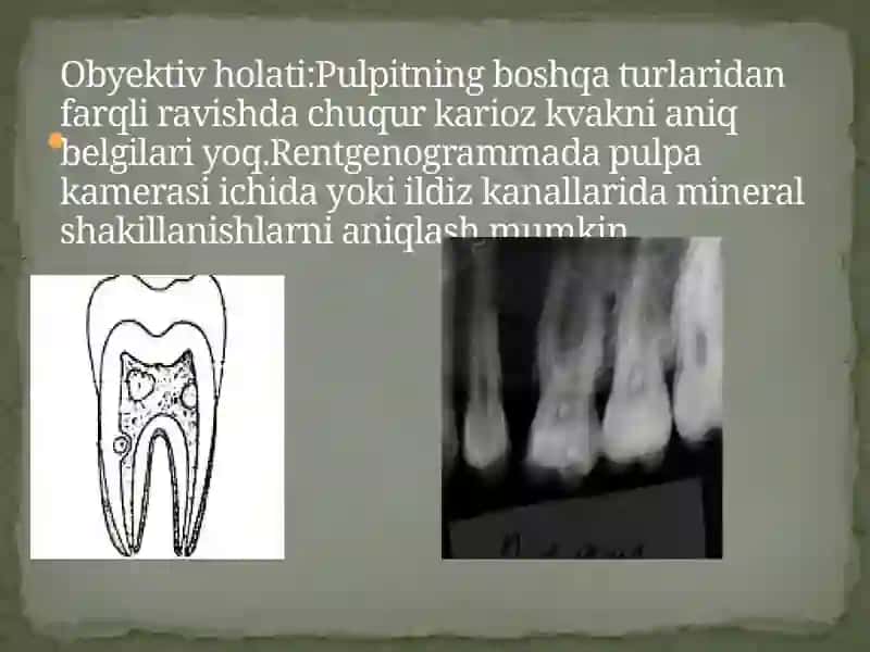 Surunkali konkrementoz pulpit 4