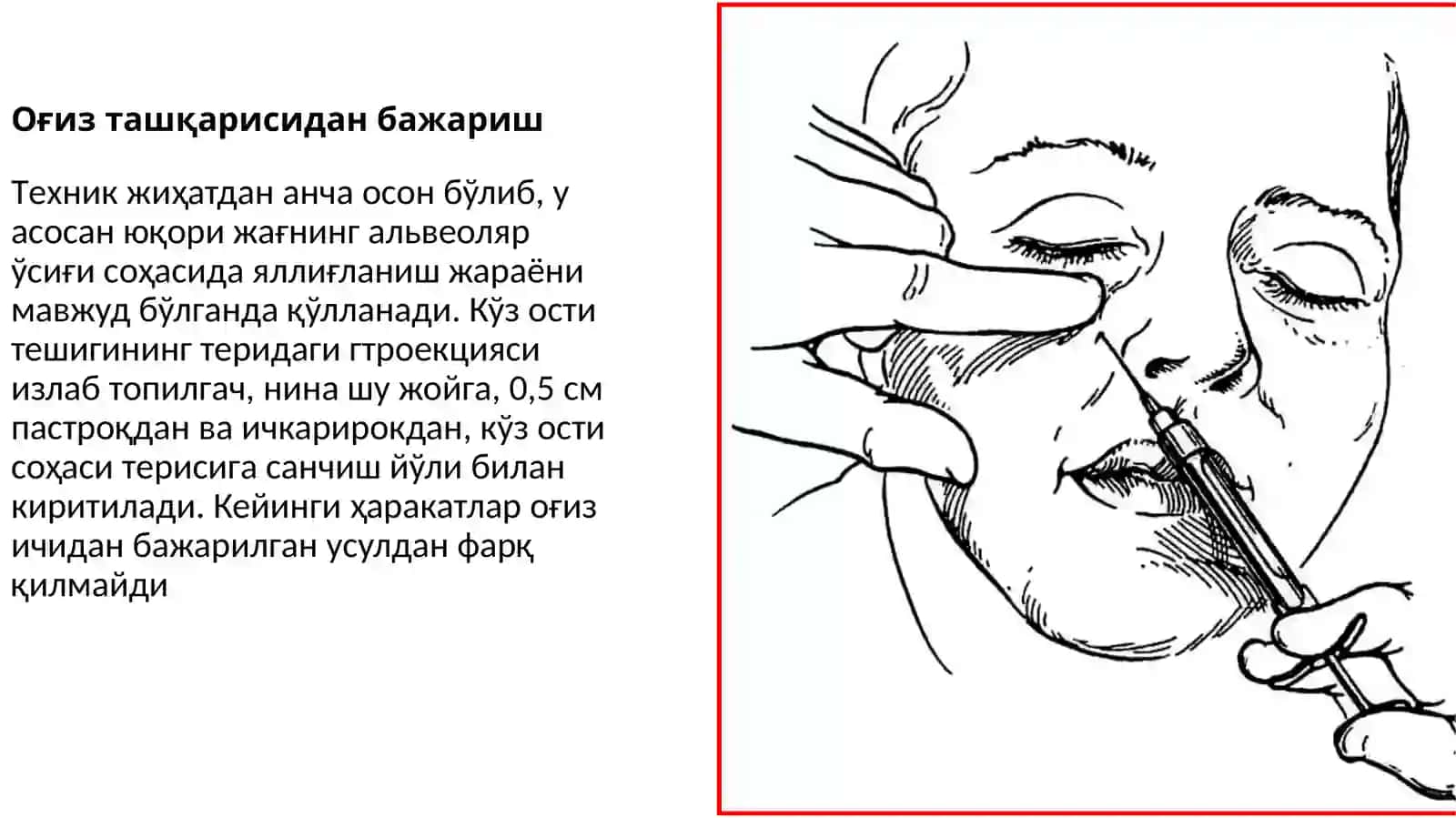 stomatologiyada og‘riqsizlantirishlar. infraorbital, insizival, palatinal. 4