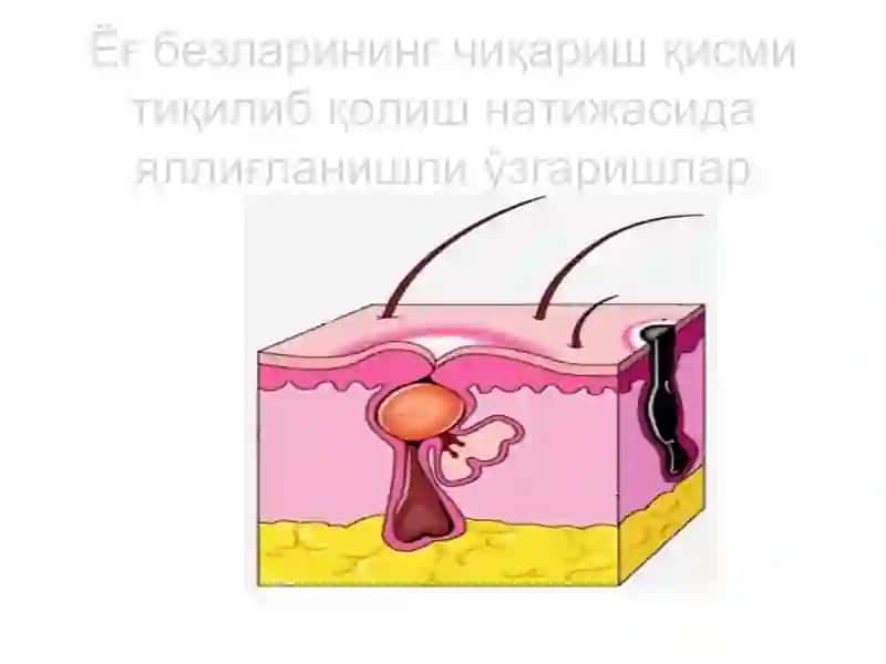 Хусунбузарлар (угри) 4