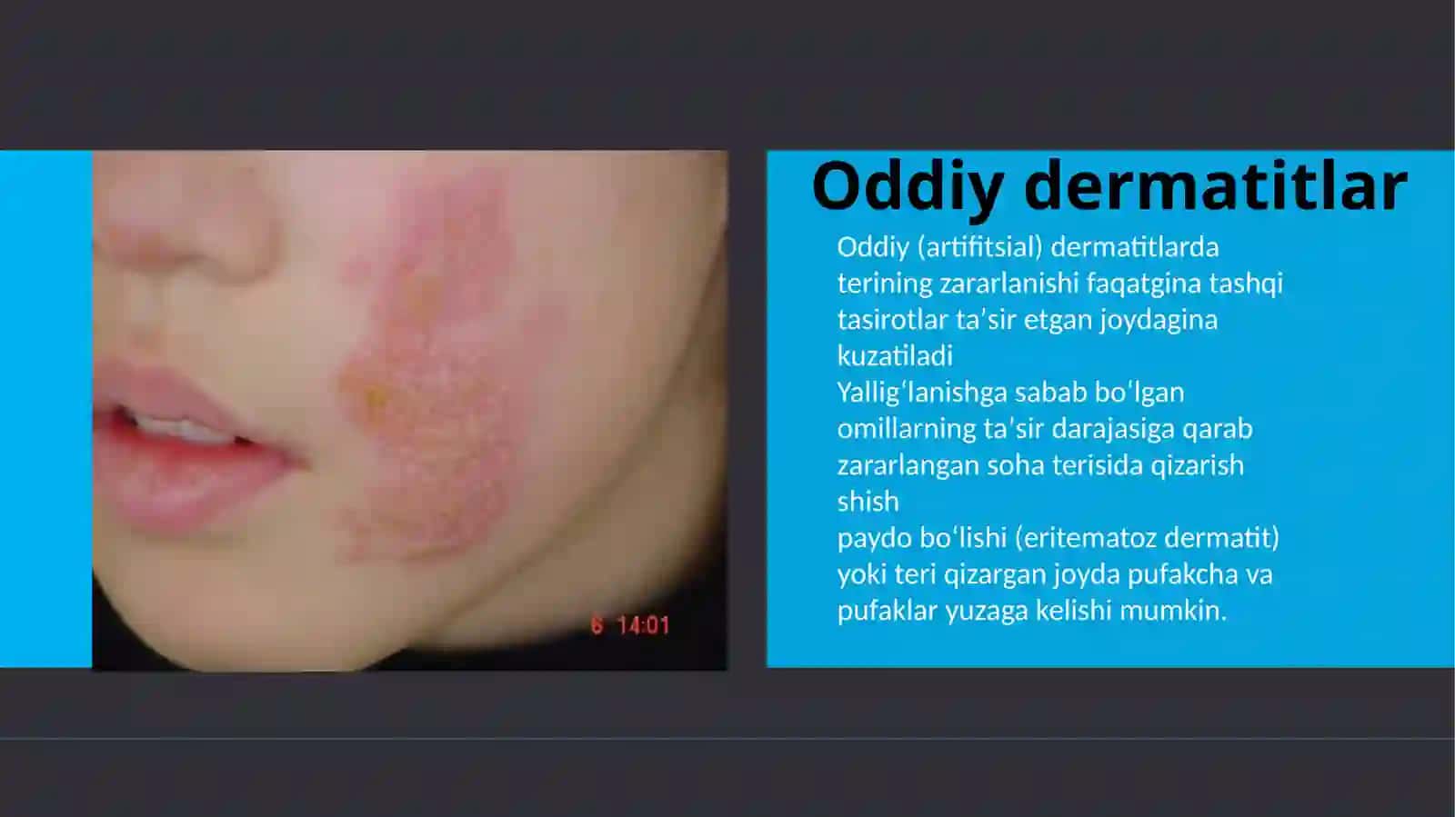 Oddiy va allergik kontakt dermatit. Toksik-allergik dermatit. Ekzema 4