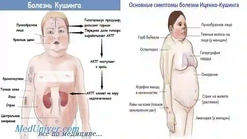 Itsenko Kushing kasalligi 4