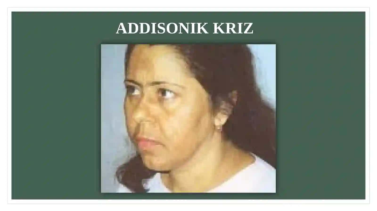 ADDISONIK KRIZ (O’TKIR BUYRAK USTI BEZI YETISHMOVCHILIGI) 4