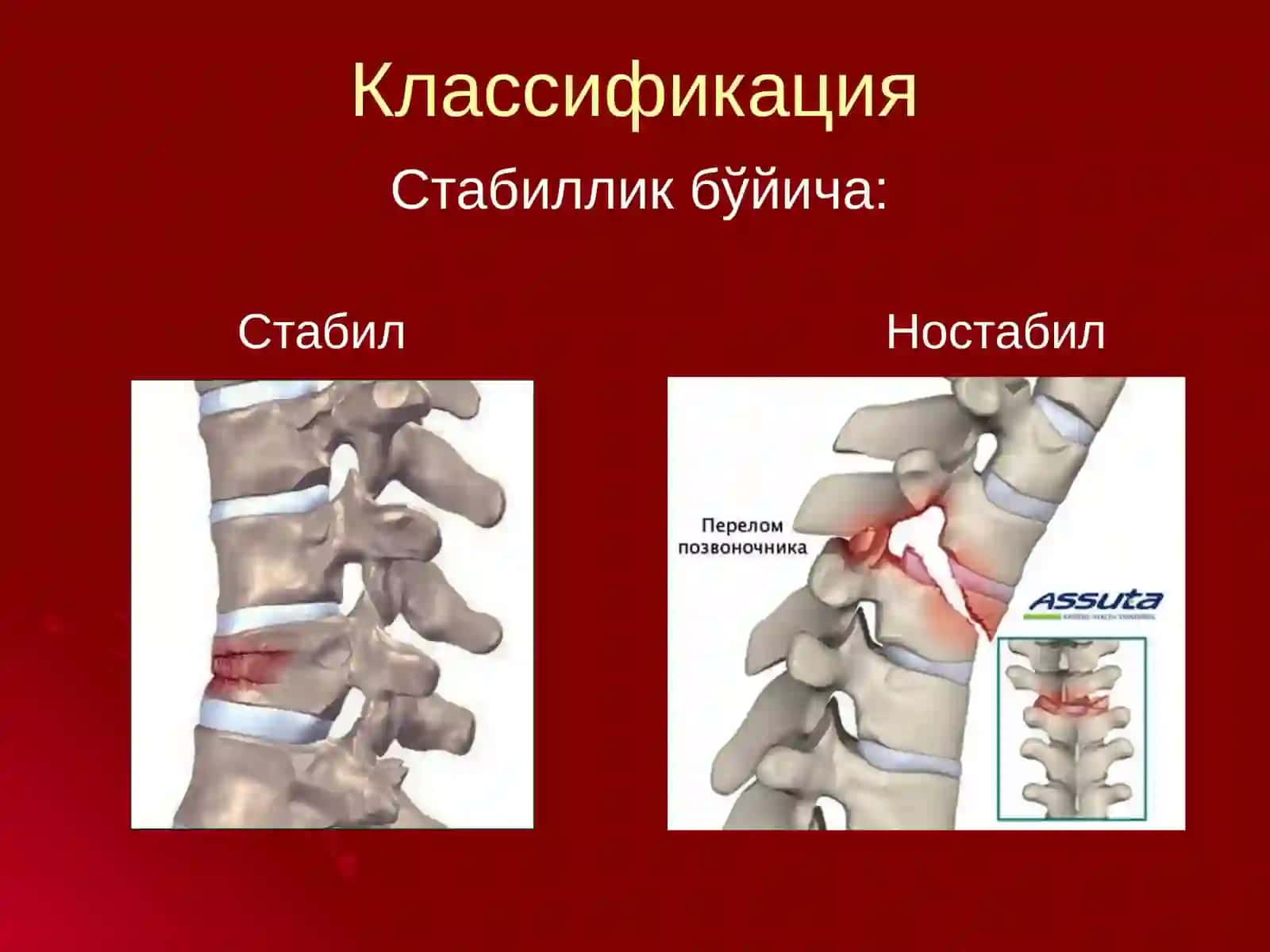 Umurtqa pog`onasi va orqa miya jarohatlari 4