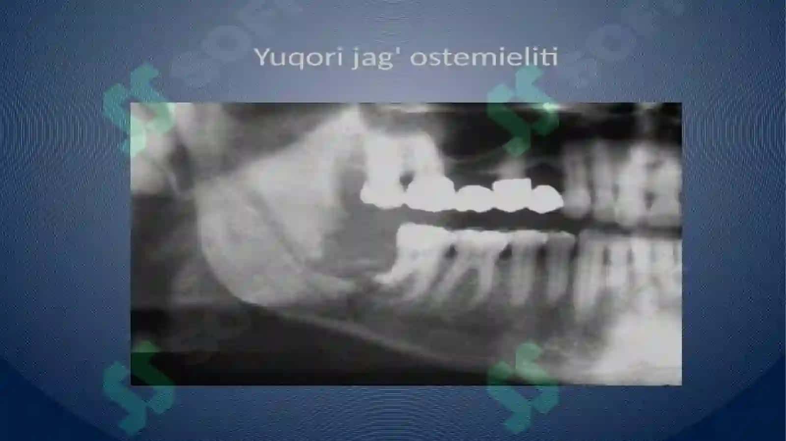 Yuqorijag‘vayuz sohasi fassial bo‘shliqlari ning anatomiyasi 4