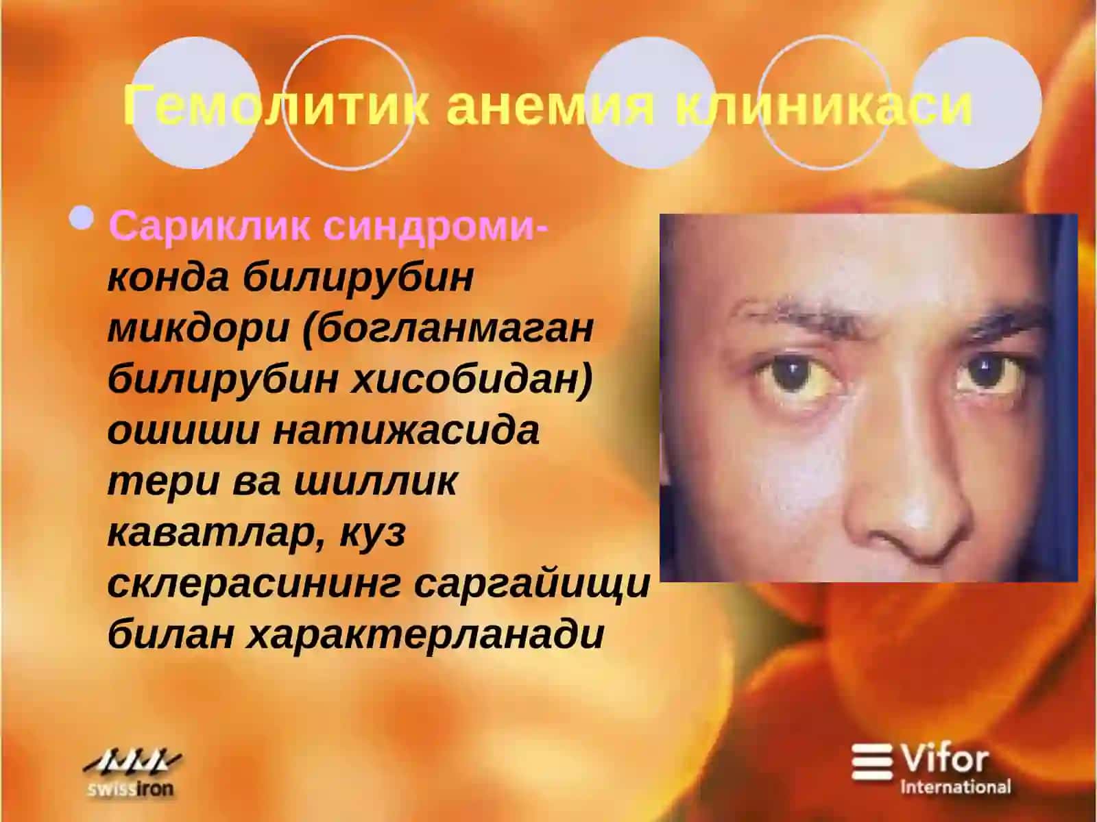 Гемолитик анемия 4