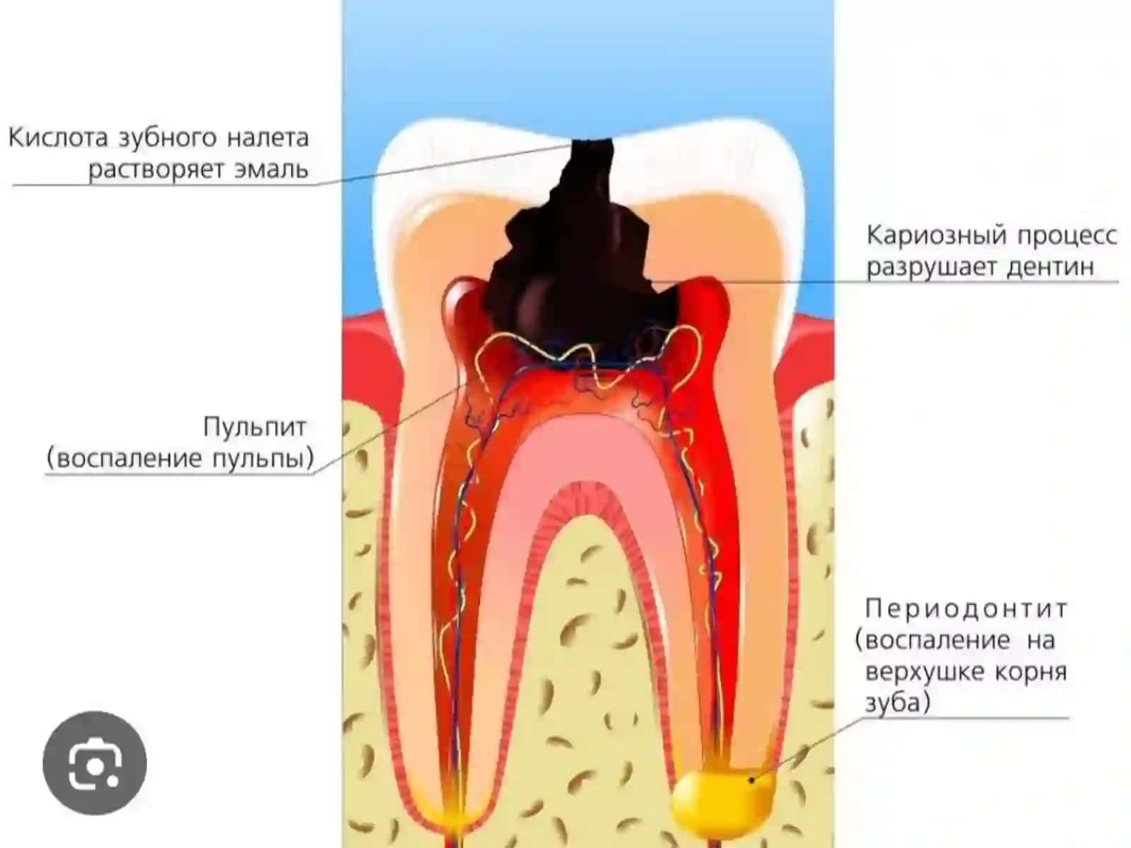O'tkir periodontitning shakllarida birinchi yordam ko'rsatish 4