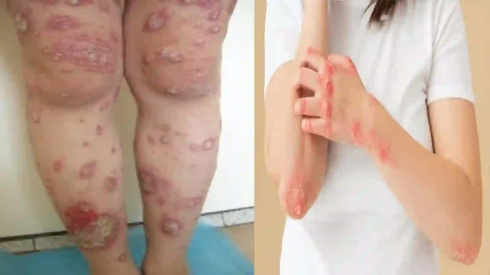 Dermatonevralogiya fanidan mustaqil ish 4