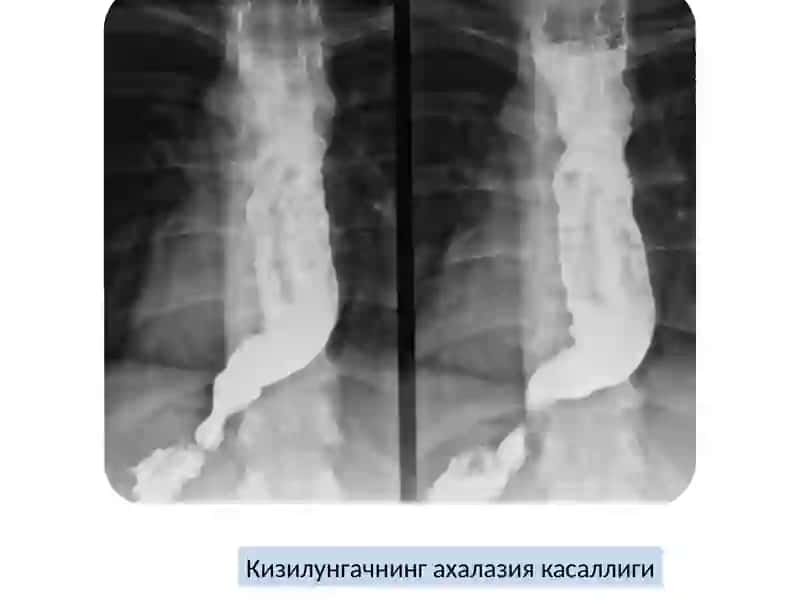 КИЗИЛУНГАЧ ВА МЕЪДА 4
