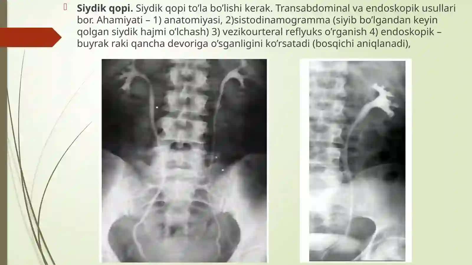 Buyrak va Siydik Yullari Normal Radiologik Anatomiyasi va Tekshirish Usullari 4