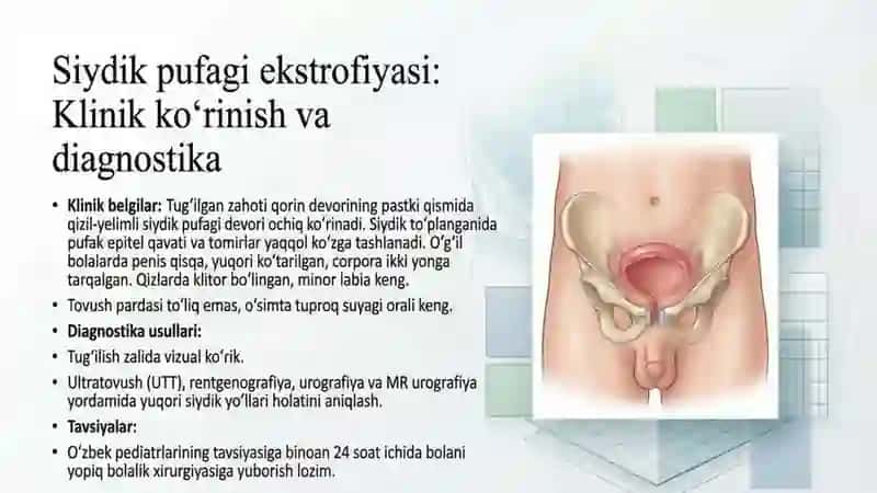 Kichik chanoq a'zolari tug'ma nuqsonlari ekstrofiya, siyodik pufaki divertikuli, to'g'ri ichak 4
