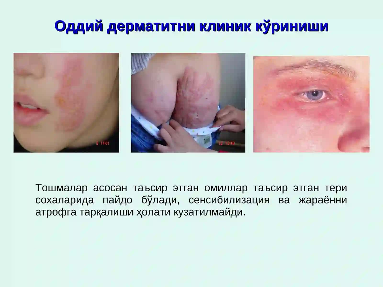 Аллергодерматозлар 4