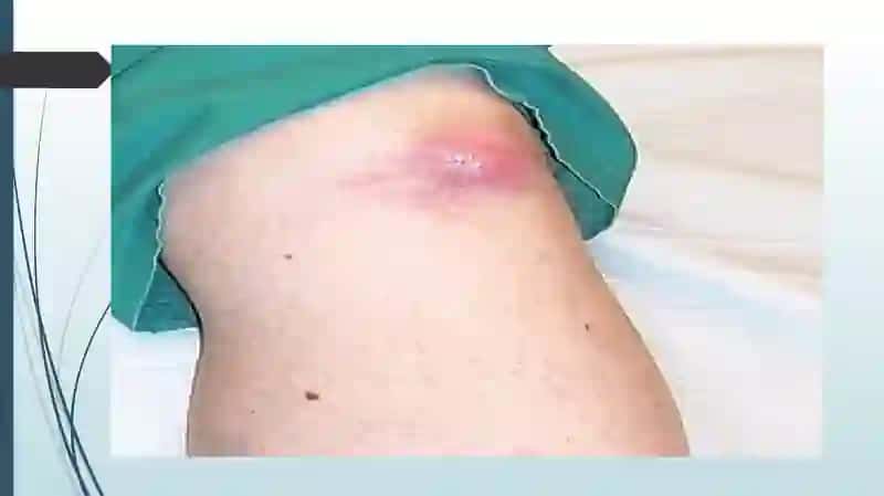 Podagra kasalligi 4