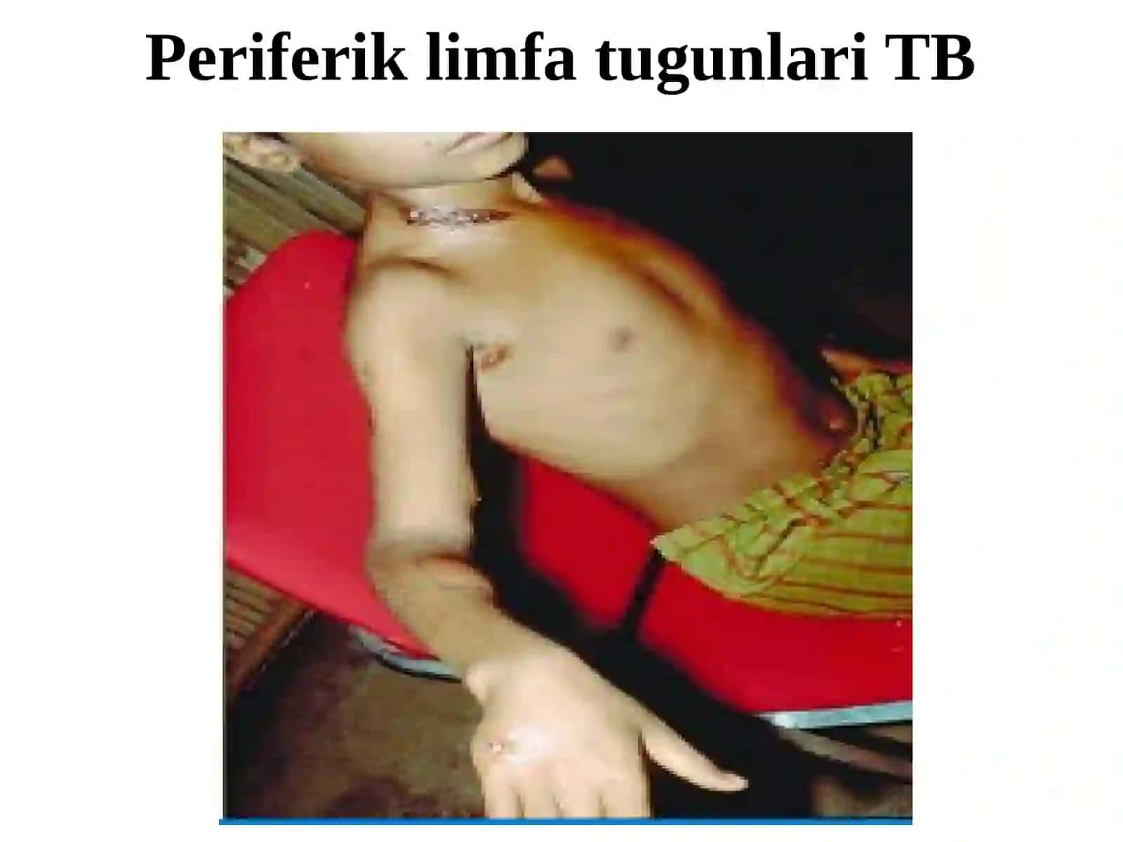 Periferik limfa tugunlari sili, sil mezoadeniti 4