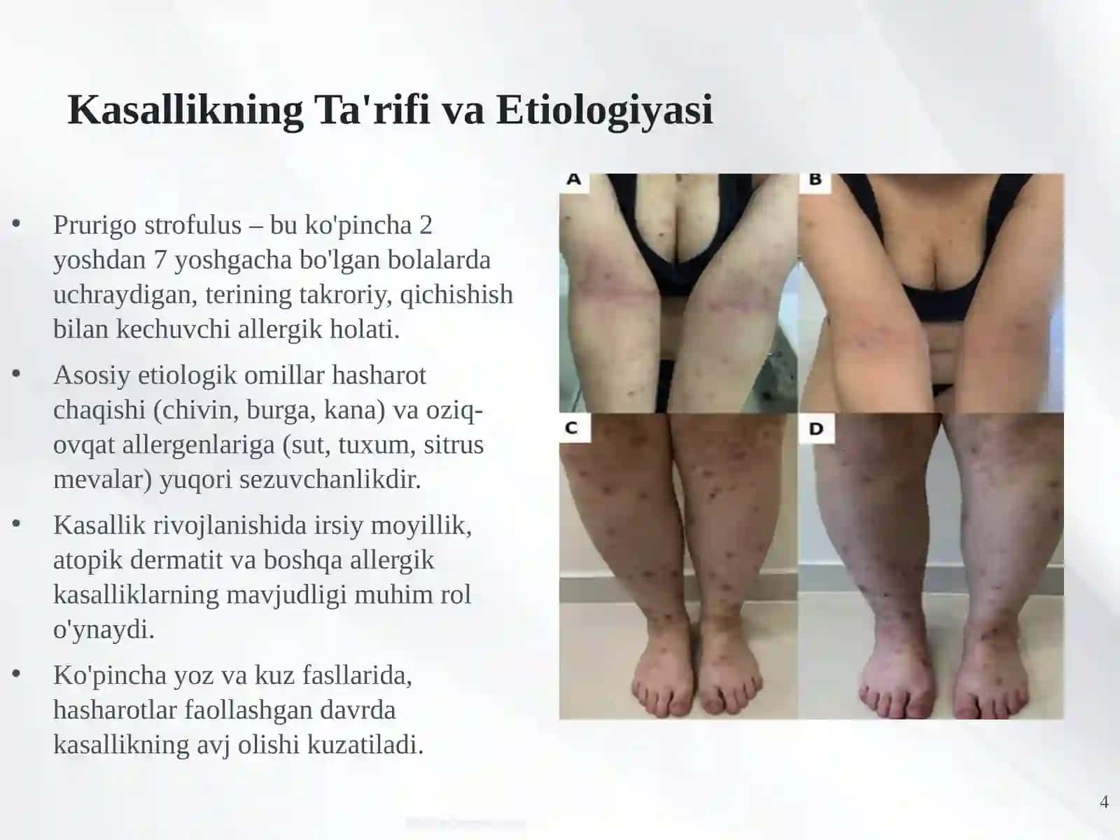 Qichima Kasalligi (Prurigo Strofulus): Keng Qamrovli Tahlil 4