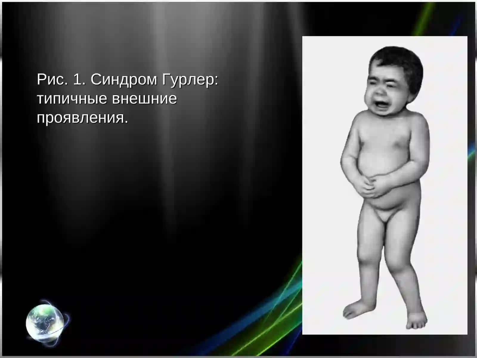 Мукополисахаридозы 4