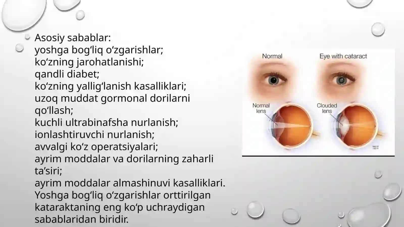 ORTTIRILGAN KATARAKTA 4