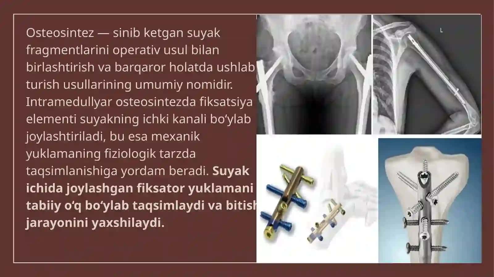 BIOS usuli (bloklovchi intramedullyar osteosintez) 4