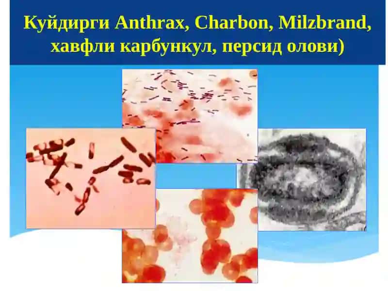 Куйдирги касалликлар 4