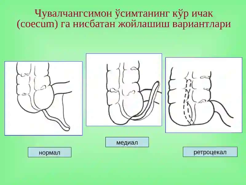 O’tkir appendetsit asoratlari 4
