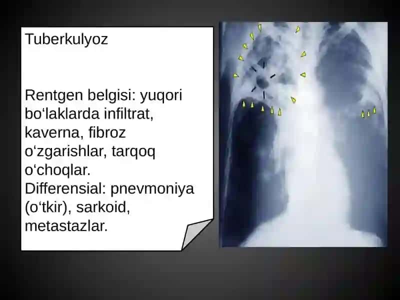 Rentgen bo‘yicha differensial diagnostika 4