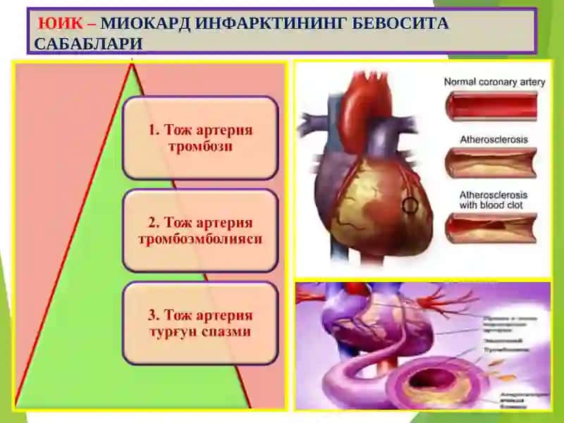 Юрак ишемик касаллиги. Цереброваскуляр касаллик 4