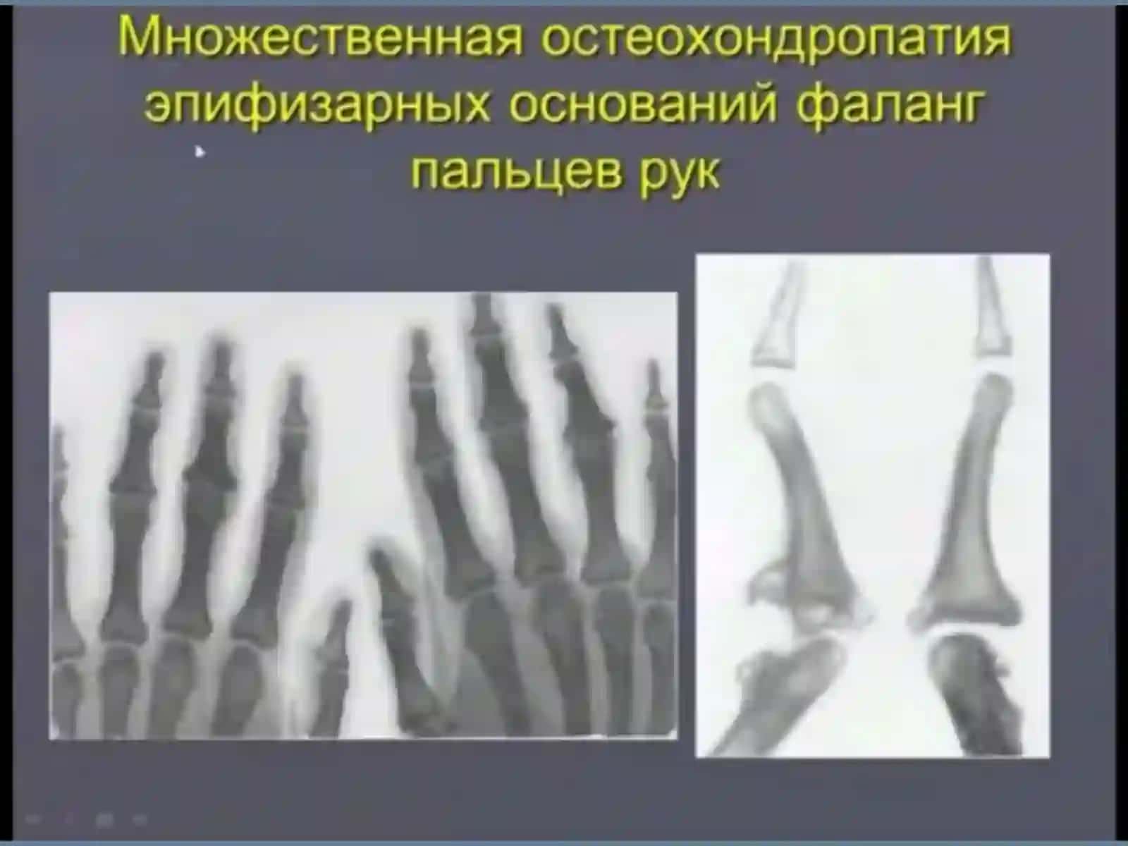 OSTEOXONDROPATIYA 4