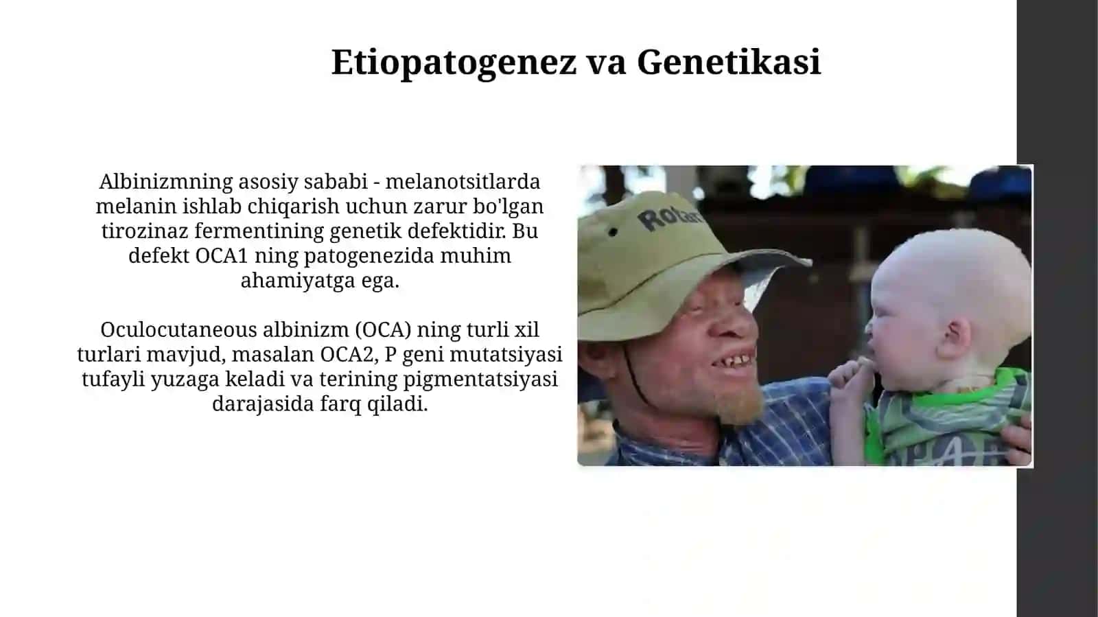 Albinizm etiopotogenezi, klinikasi, diagnostikasi, davolash vaprofilaktikasi 4