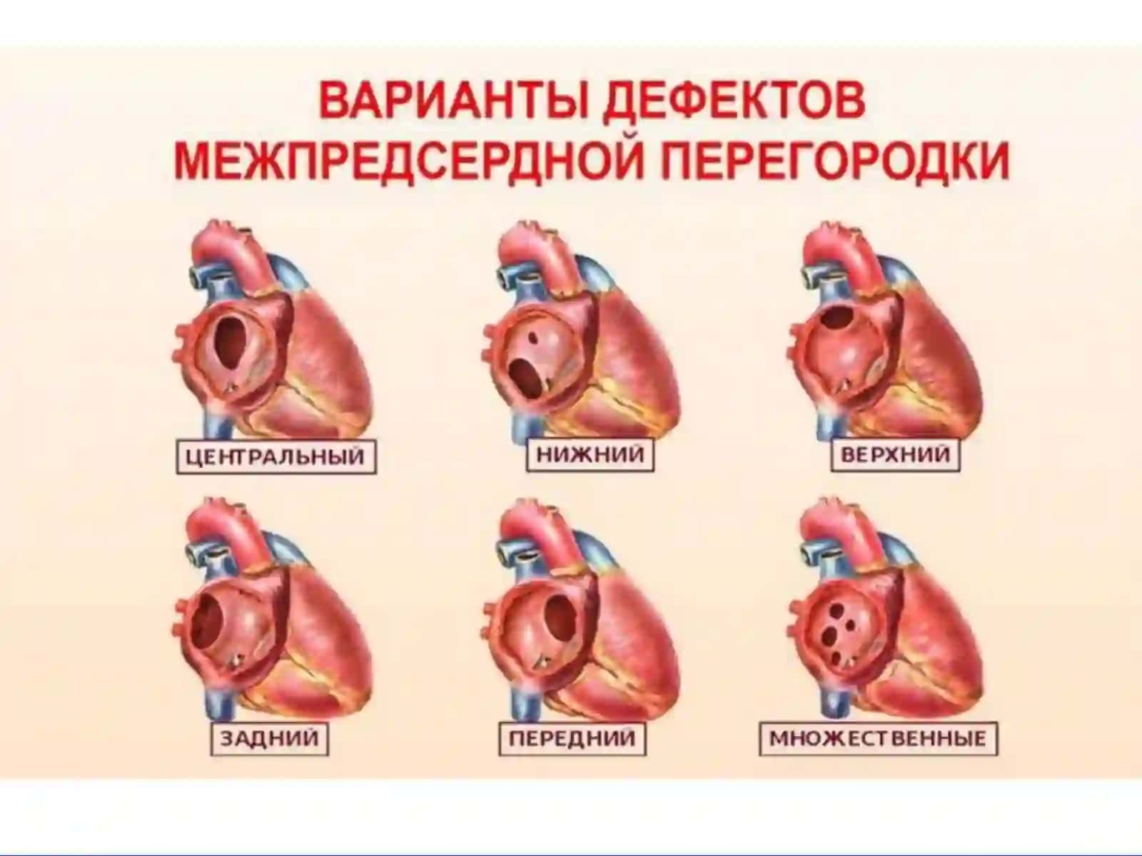 Tugma yurak kasalliklari (Fallo tetradasi, asosiy stvol transpozitsiyasi) 4