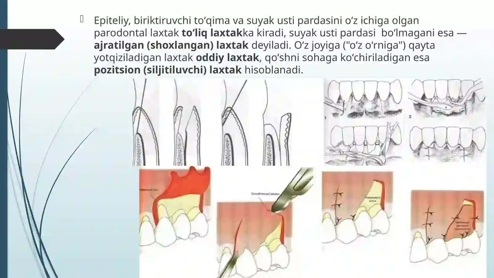 Parodontal xirurgiyada laxtakli operatsiyalar. 4