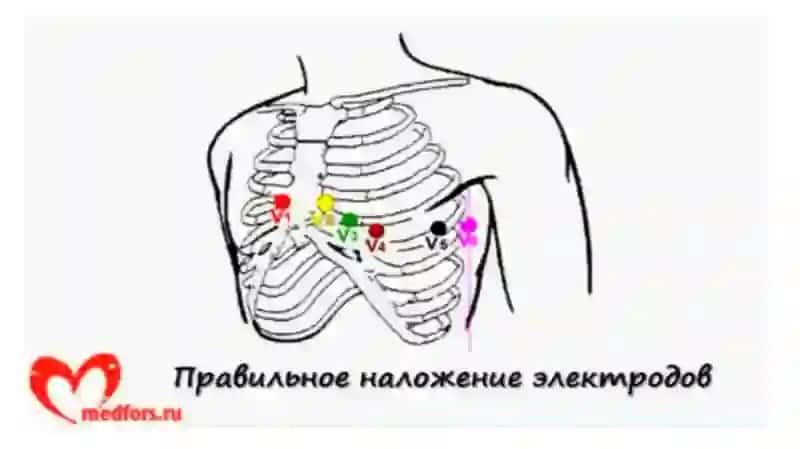 ЭКГ асослари 4