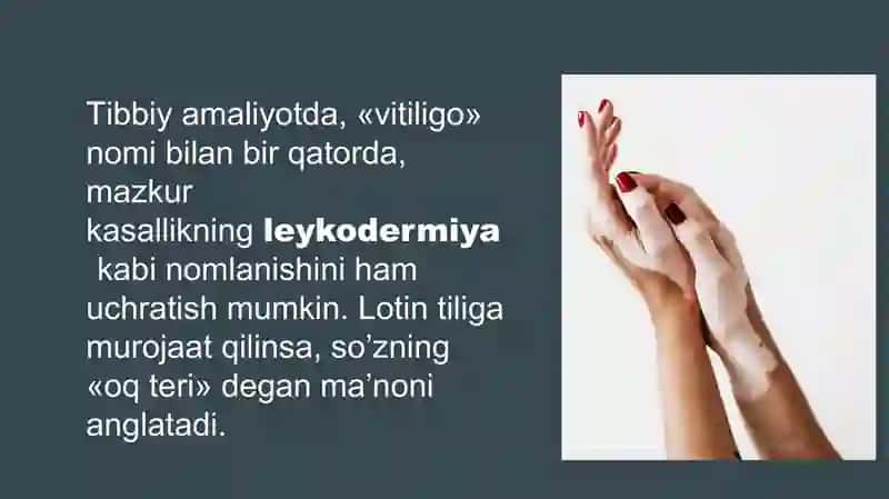 VITILIGO va  UNING ZAMONAVIY DAVOLASH USULLARI 4