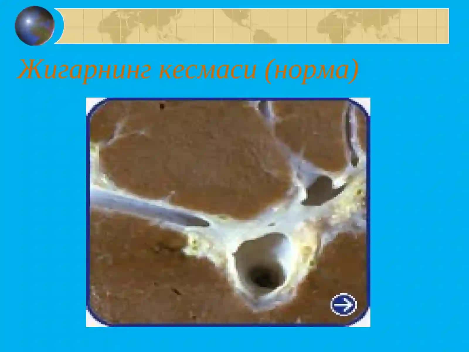 СУРУНКАЛИ ГЕПАТИТ Surunkali Gepatit 4